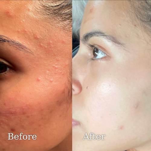 Solard Exfoliating Serum