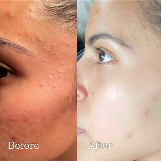 Solard Exfoliating Serum